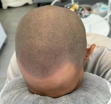 Can Hair Grow Over Scalp Micropigmentation