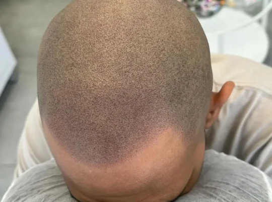 Can Hair Grow Over Scalp Micropigmentation