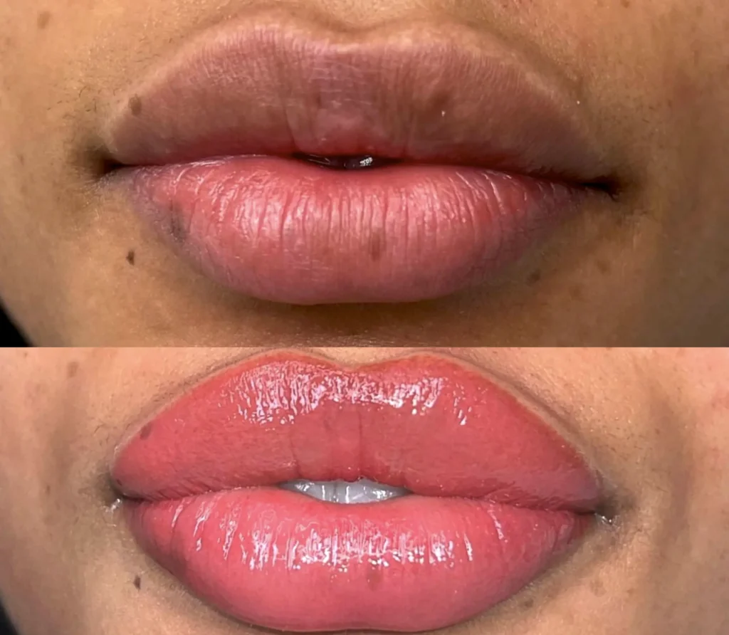 Dark lip neutralization