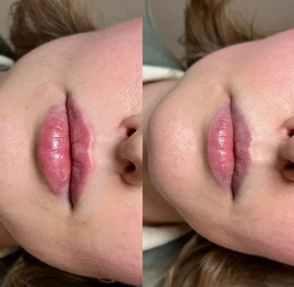 cosmetic procedure